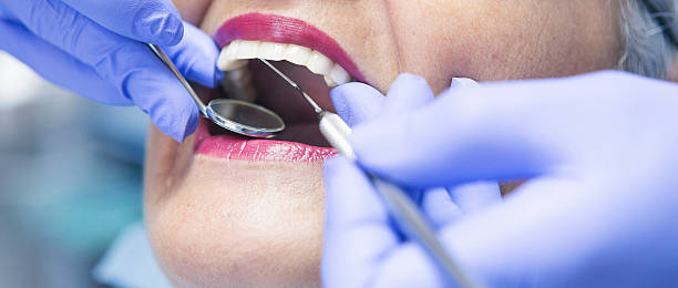 Best Emergency Wisdom Tooth Extraction in Los Ranchos, CA